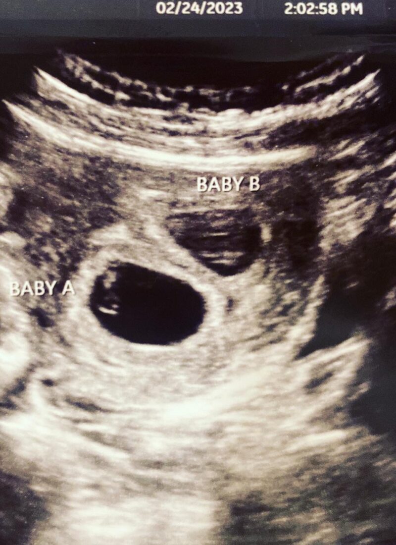 Twin pregnancy #2/ My Second Twin Birth Story